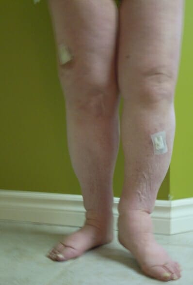 Lymphoedème (pieds/jambes) - Après traitement