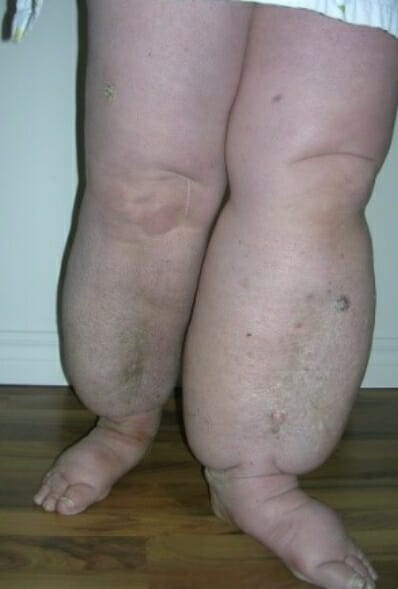 Lymphoedème (pieds/jambes) - Avant traitement