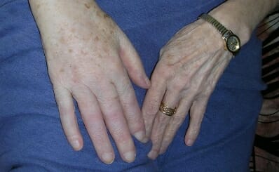 Lymphoedème (mains) - Avant/Après traitement
